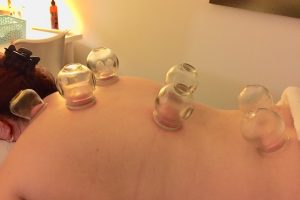 Cupping at Shine Health Wellbeing Centre